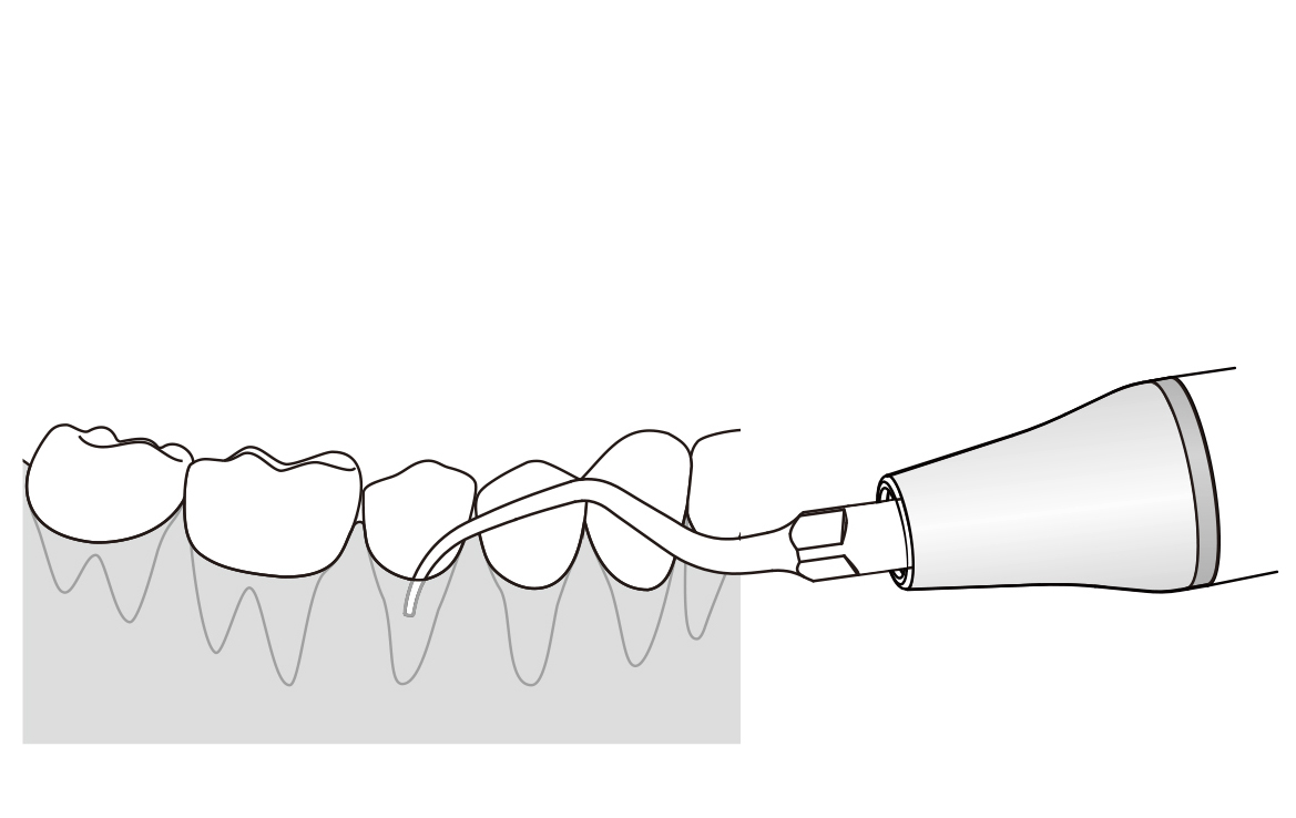 Сфера применения наконечника для скалера